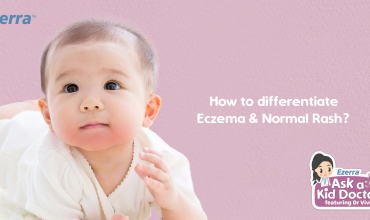 Eczema vs Common Rashes